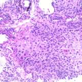 Histopathology of squamous cell carcinoma of the lung