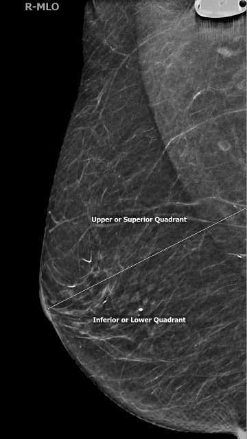 Screening Mammogram: Breast Lesion Localization Figure 2