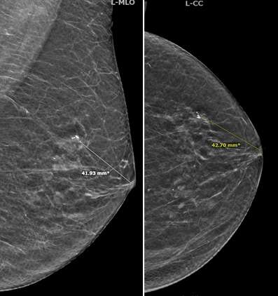 Screening Mammogram: Breast Lesion Localization Figure 8