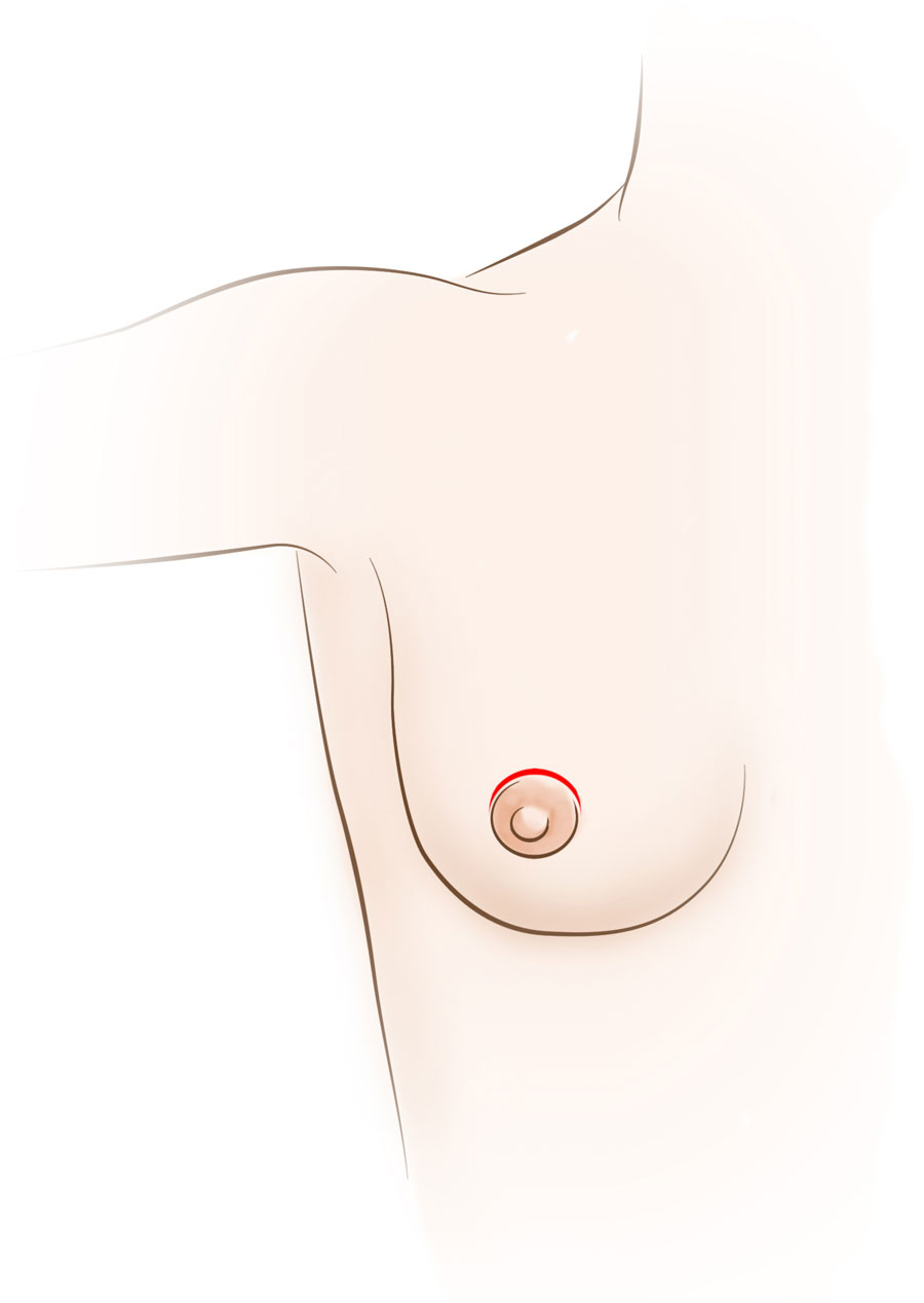 Lumpectomy - National Breast Cancer Foundation