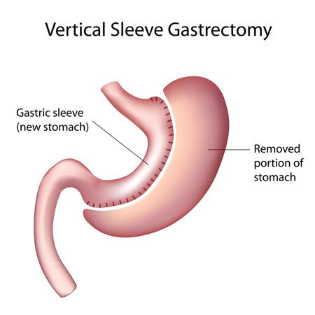 5 Ways to Faster Recovery After Gastric Sleeve Surgery - Body