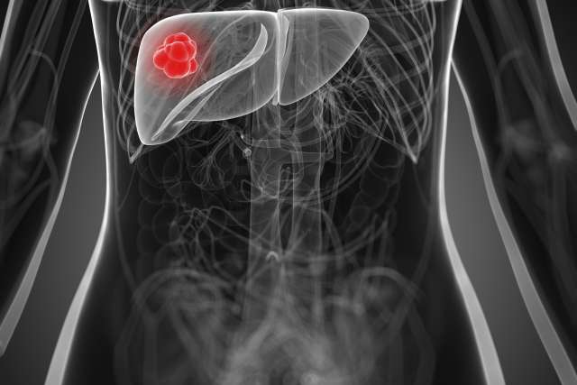 Tumor on liver