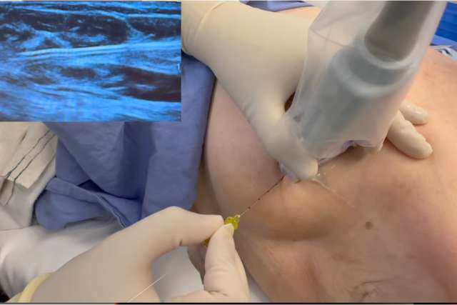 Breast ultrasound procedure