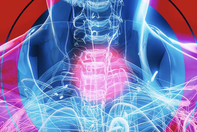 Illustration showing Barrett's esophagus