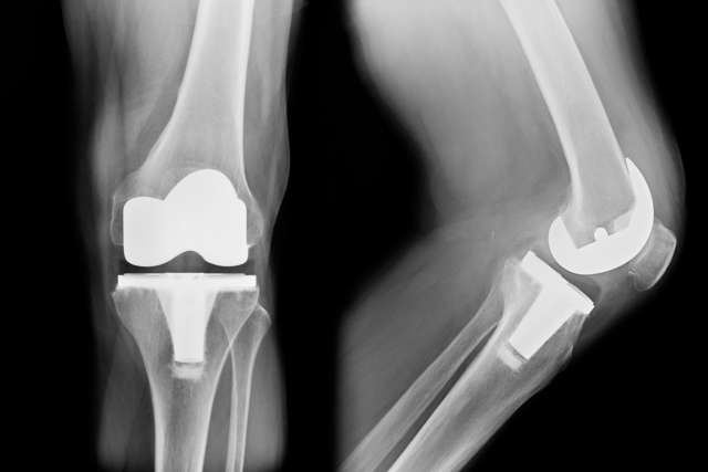 TKA x-ray, total knee replacement frontal and lateral view