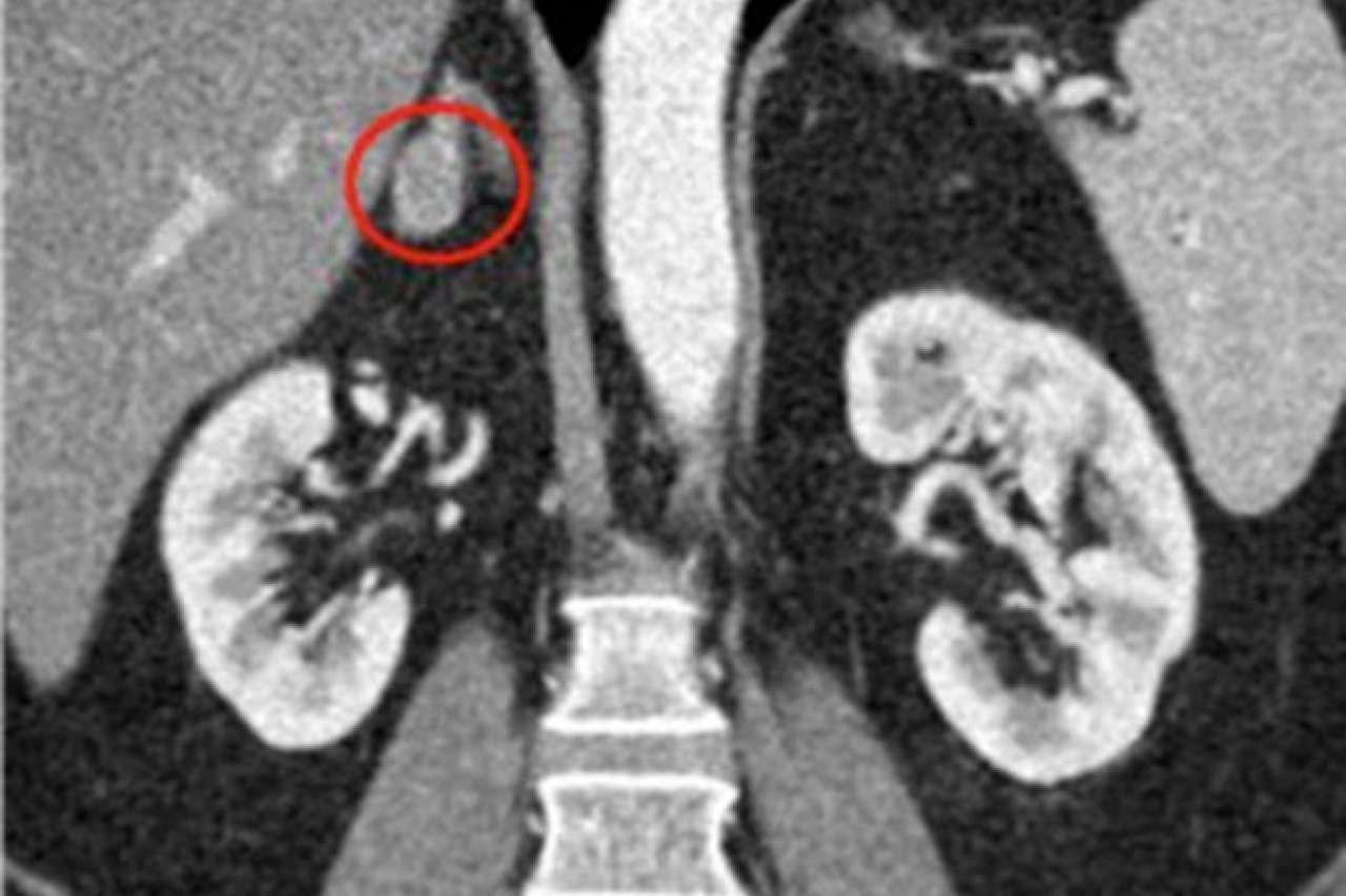 Abdominal Imaging for Adrenal Tumors