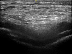 An ultrasound image of a large calcium deposit in the knee cartilage.