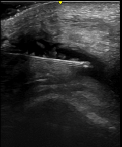 Ultrasound used to accurately guide needle placement into a joint effusion