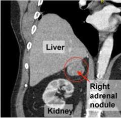 Image of adrenal tumor