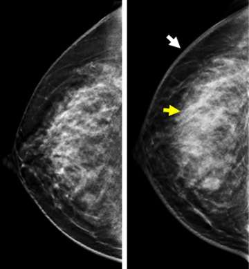 Inflammatory Breast Cancer - Radiology | UCLA Health