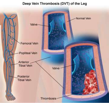 Deep Venous Thrombosis (DVT): Symptoms, Diagnosis, and Treatment: Vascular  Surgery Associates, LLC: Vascular Surgery