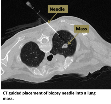 Lung Biopsy - Interventional Radiology | UCLA Health