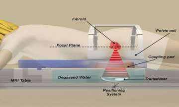 Focused Ultrasound For Fibroids - Fibroids | UCLA Health