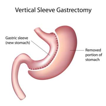Gastric Sleeve, Sleeve Gastrectomy, VSG (Vertical Sleeve