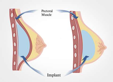 Breast MRI Findings Breast Implant Radiology UCLA Health