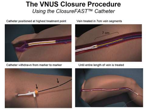 The Closure Procedure and Catheter Venous Care UCLA Health