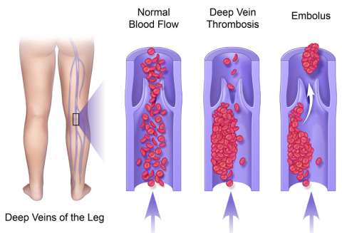 Illustrations of a typical clot configuration within the flow