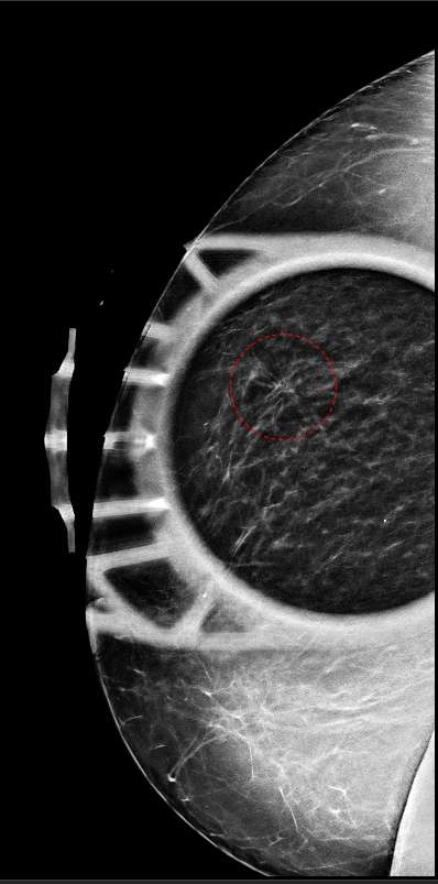 Architectural Distortion - Radiology | UCLA Health