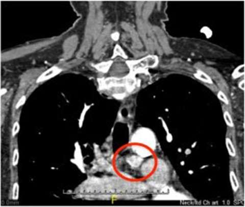 Parathyroid CT Scan