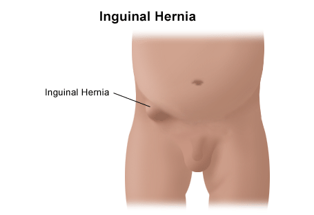 The Truth About Hernia Mesh, Department of Surgery