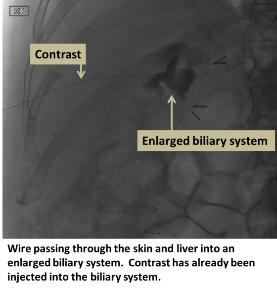 Biliary Drainage - Interventional Radiology | UCLA Health