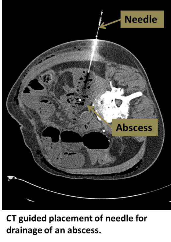 Drainage Percutaneous Interventional Radiology Ucla Health