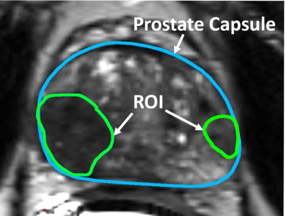 Ultrasound-mri Fusion For Targeted Diagnosis Of Prostate Cancer - Casit 