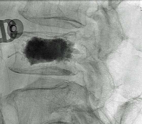 Vertebroplasty Kyphoplasty Sacroplasty Interventional