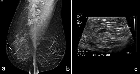 Axillary Lymphadenopathy Radiology UCLA Health