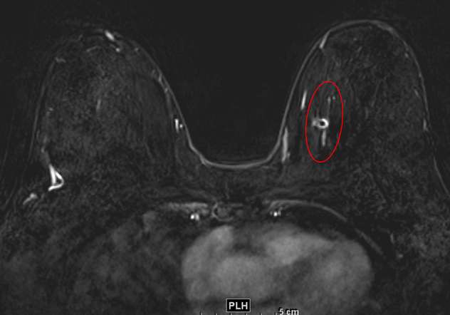 Breast MRI Findings Non Mass Enhancement NME Radiology UCLA