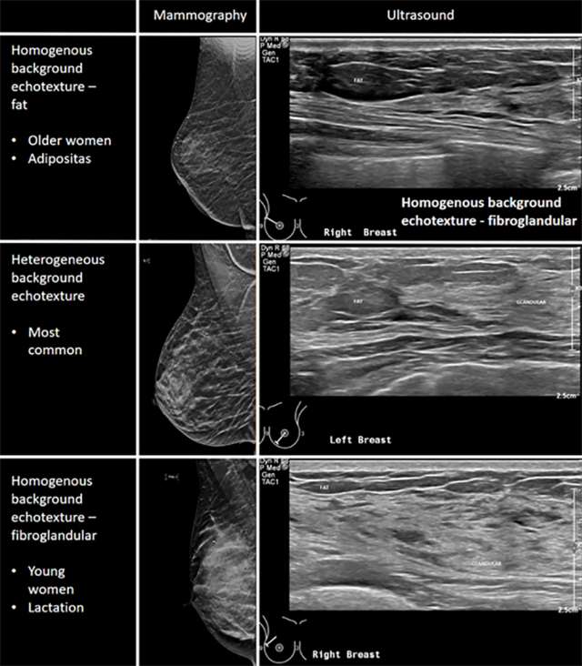 Basics Of Breast Ultrasound - Radiology | UCLA Health