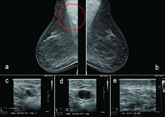 Axillary Lymphadenopathy Radiology UCLA Health