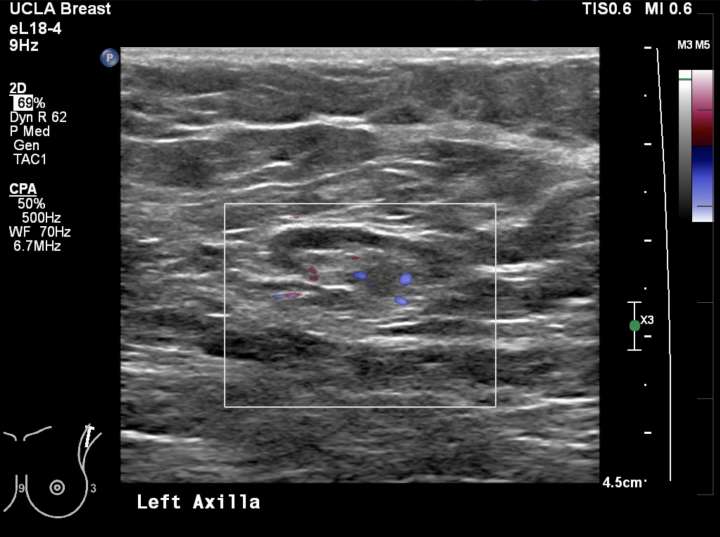 Axillary Lymphadenopathy Radiology Ucla Health 