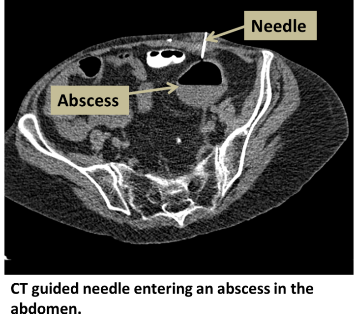 Drainage Percutaneous - Interventional Radiology | UCLA Health