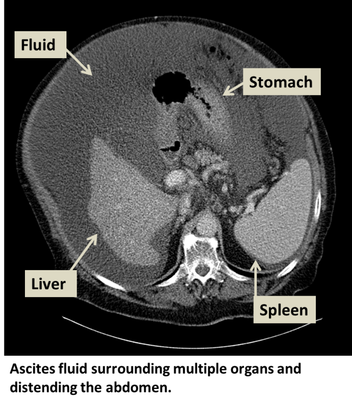 Ascites Interventional Radiology Ucla Health 0853