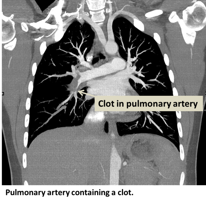 Pulmonary Embolism (PE) - Interventional Radiology | UCLA Health