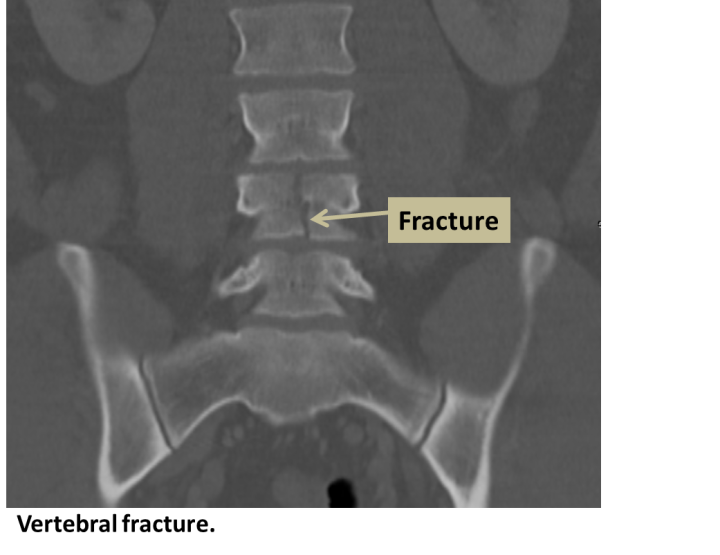 Vertebral Fracture - Interventional Radiology | UCLA Health