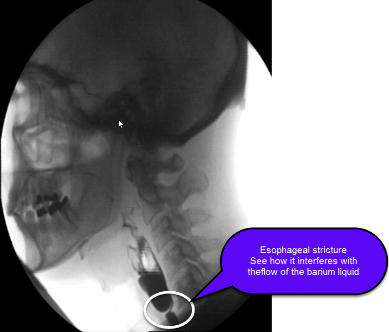 Esophageal Stricture - Esophageal Health | UCLA Health