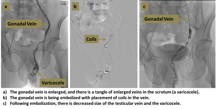 Varicocele Embolization Interventional Radiology Ucla Health