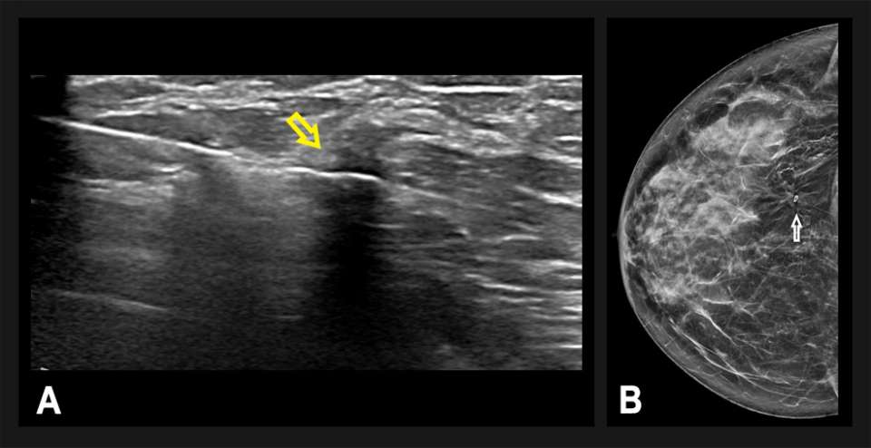 Case Architectural Distortion Radiology UCLA Health   Case Architectural Distortion Fig3 