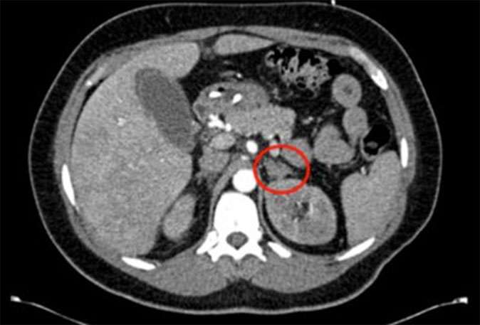 Abdominal Imaging for Adrenal Tumor