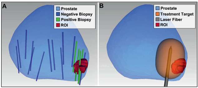 Focal Laser Ablation For Prostate Cancer Treatment Casit Ucla Health 2443