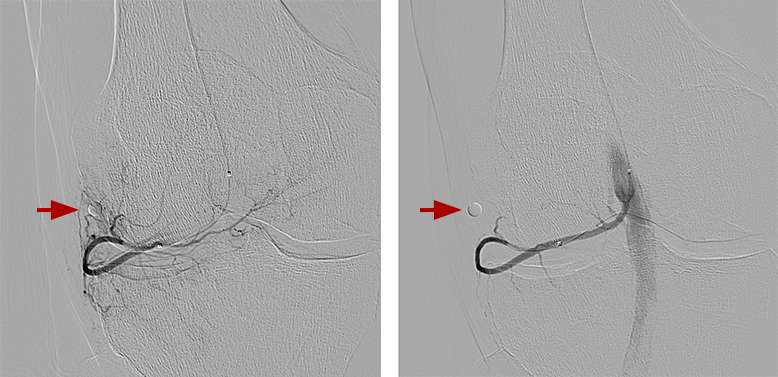 Genicular Artery Embolization (GAE) - Interventional Radiology | UCLA ...