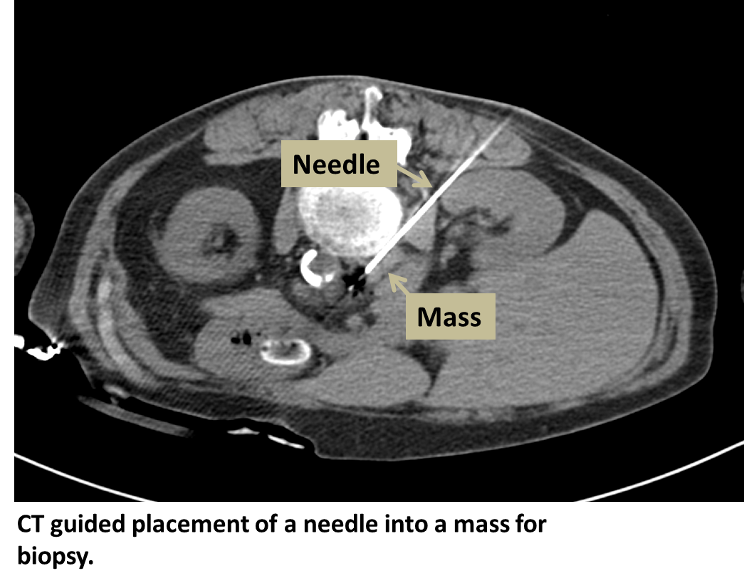 Biopsy Percutaneous - Interventional Radiology | UCLA Health