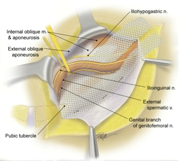 Chronic Pain After Hernia Surgery - Hernia Care | UCLA Health