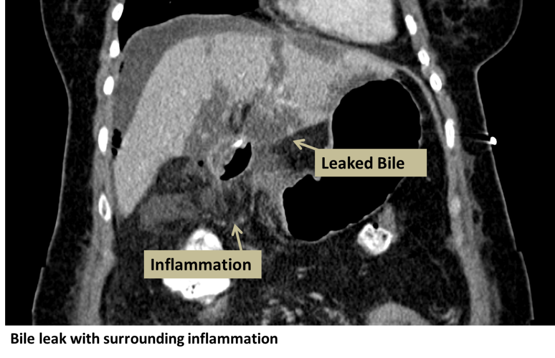 Biliary Leak - Interventional Radiology | UCLA Health