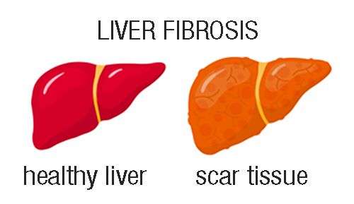 Testing For Fibrosis - Hepatology | UCLA Health