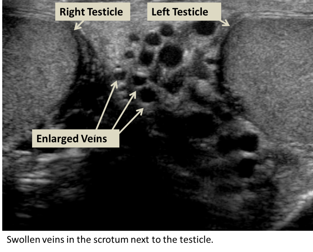 Varicocele Interventional Radiology Ucla Health