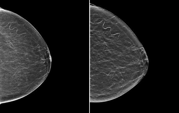 2D vs. 3D Tomosynthesis - Radiology | UCLA Health