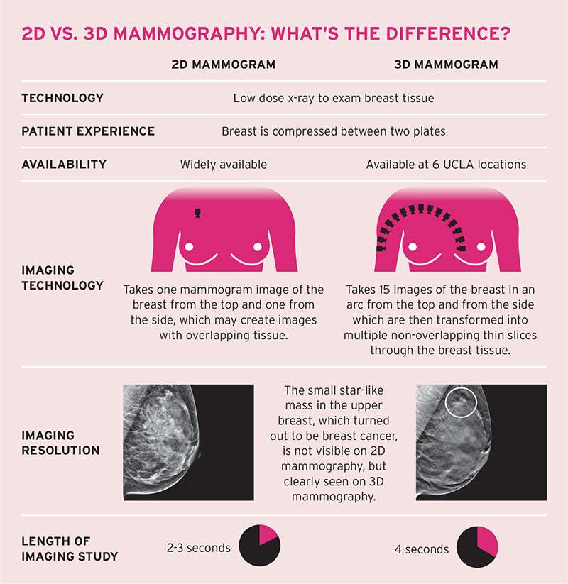 Breast Imaging: 3D Mammography (Tomosynthesis) - Breast Imaging | UCLA ...